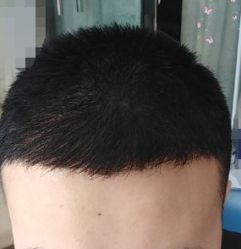 -大麦微针植发丨全国连锁