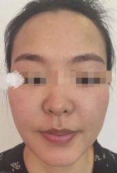 体验后-洁铭新加坡医美