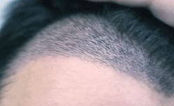 -大麦微针植发全国连锁