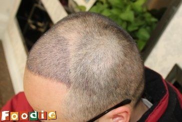 -大麦微针植发丨全国连锁