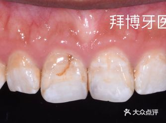 这位患者是个二十多岁的小姑娘；之前因为喜欢吃甜食