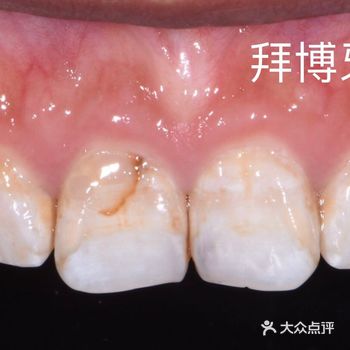 这位患者是个二十多岁的小姑娘；之前因为喜欢吃甜食