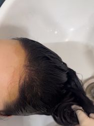 体验后-大麦微针植发全国连锁