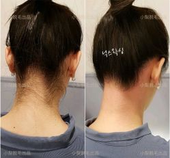 -小梨·OndaPro·专业脱毛连锁机构