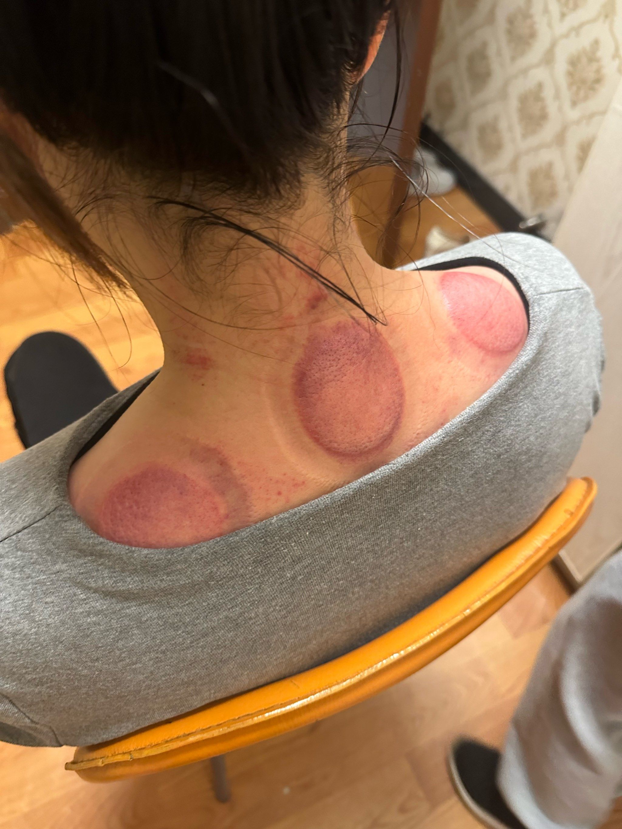 拔罐疗法,中医也能时尚!