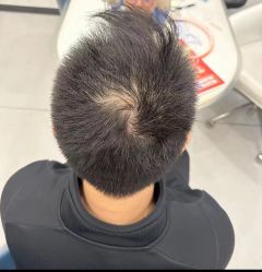 体验前-大麦微针植发全国连锁