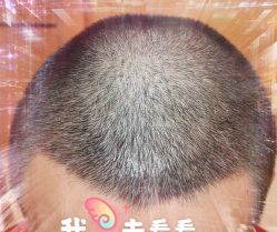 -大麦微针植发全国连锁