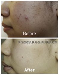 脸部抗衰-光SPA科技美肤