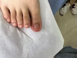 -德哥灰指甲脚气甲沟炎跖疣护理