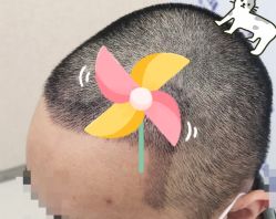 -大麦微针植发全国连锁