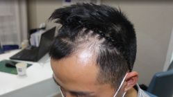 体验前-大麦微针植发全国连锁