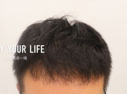 -大麦微针植发全国连锁