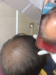 -碧莲盛·不剃发植发