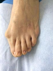 -德哥灰指甲脚气甲沟炎跖疣护理