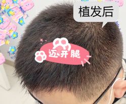 -大麦微针植发全国连锁