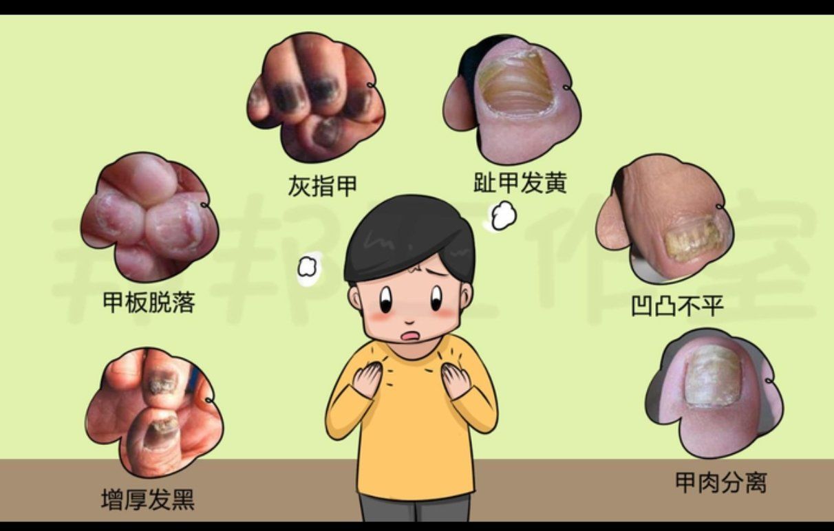 为什么会得灰指甲?多是由这4种因素造成的为什么在线 为什么会得灰指甲?多是由这4种因素造成的为什么在线