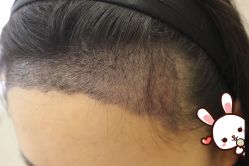 -大麦微针植发丨全国连锁