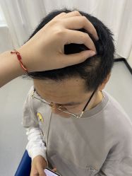 -大麦微针植发全国连锁