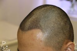 -大麦微针植发丨全国连锁