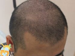 -大麦微针植发丨全国连锁