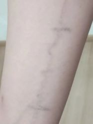-天道专业洗纹身