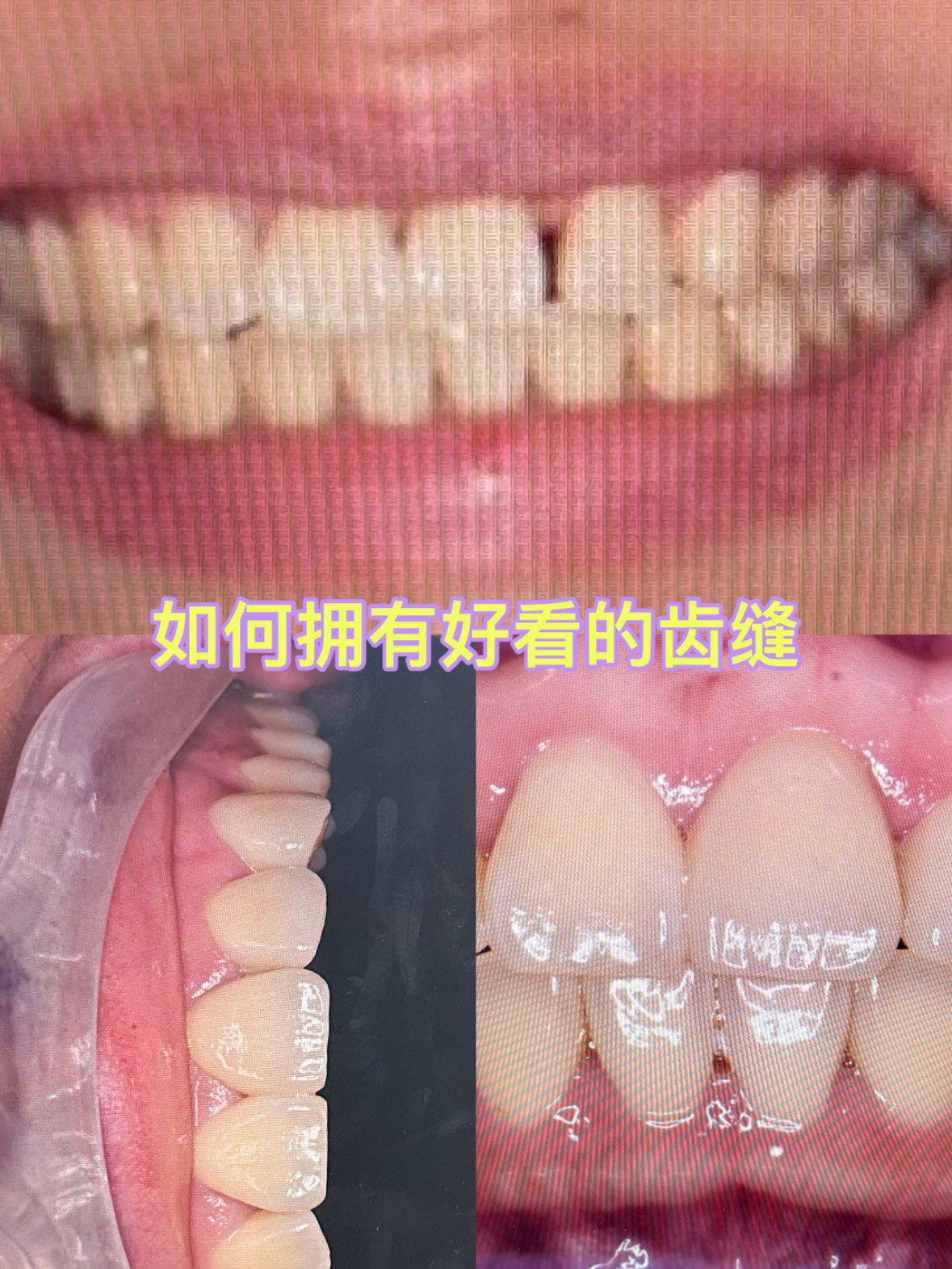 我上前牙牙齿稀疏缝隙较大,平时也不敢拍照大笑,古话都说牙缝大漏财
