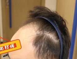 -大麦微针植发全国连锁