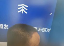 -雍禾植发全国连锁