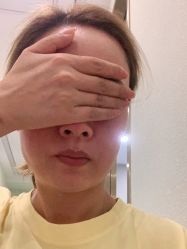 体验后-正璞医疗美容·皮肤修复·微整注射
