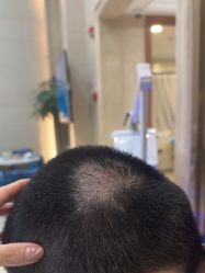 -碧莲盛·不剃发植发