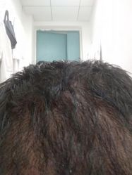 点击看大图 -大麦微针植发丨全国连锁