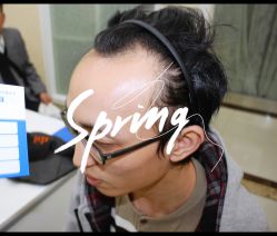 体验前-大麦微针植发全国连锁