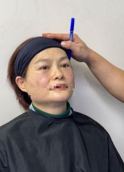 -天津健丽·去眼袋医疗美容机构