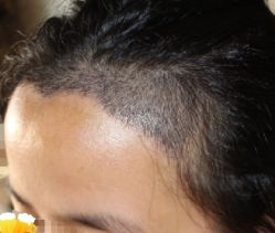 -大麦微针植发丨全国连锁