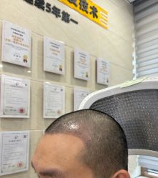 点击看大图 -大麦微针植发全国连锁