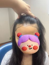 体验前-大麦微针植发全国连锁