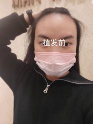 -碧莲盛·不剃发植发
