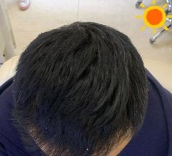 -大麦微针植发丨全国连锁