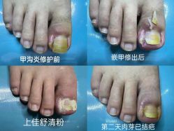 -德哥灰指甲脚气甲沟炎跖疣护理