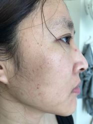 -美丽人生祛斑扁平疣汗管瘤中心