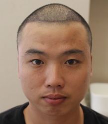 -大麦微针植发全国连锁