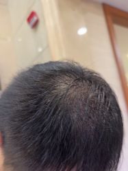 -碧莲盛·不剃发植发