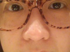 当天玩了一天后傍晚拍的，已经消肿不少了-上海华安整形外科门诊部