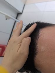 -大麦微针植发丨全国连锁