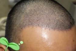 -大麦微针植发丨全国连锁