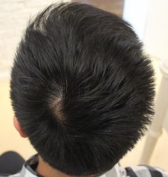 -大麦微针植发丨全国连锁
