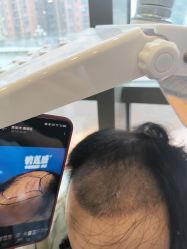 -碧莲盛·不剃发植发