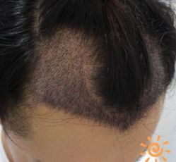 -大麦微针植发丨全国连锁