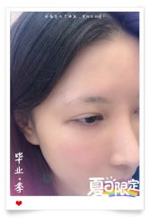 -大麦微针植发全国连锁