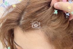 -大麦微针植发全国连锁